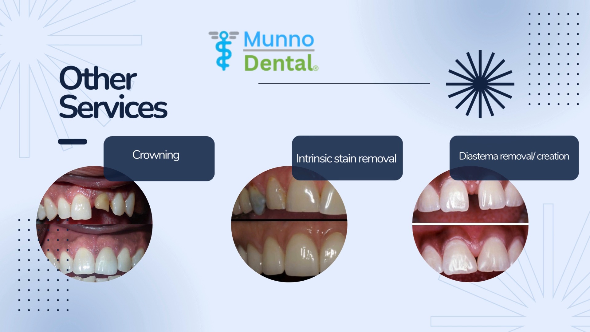 Crowns, stain removal and tooth gap care